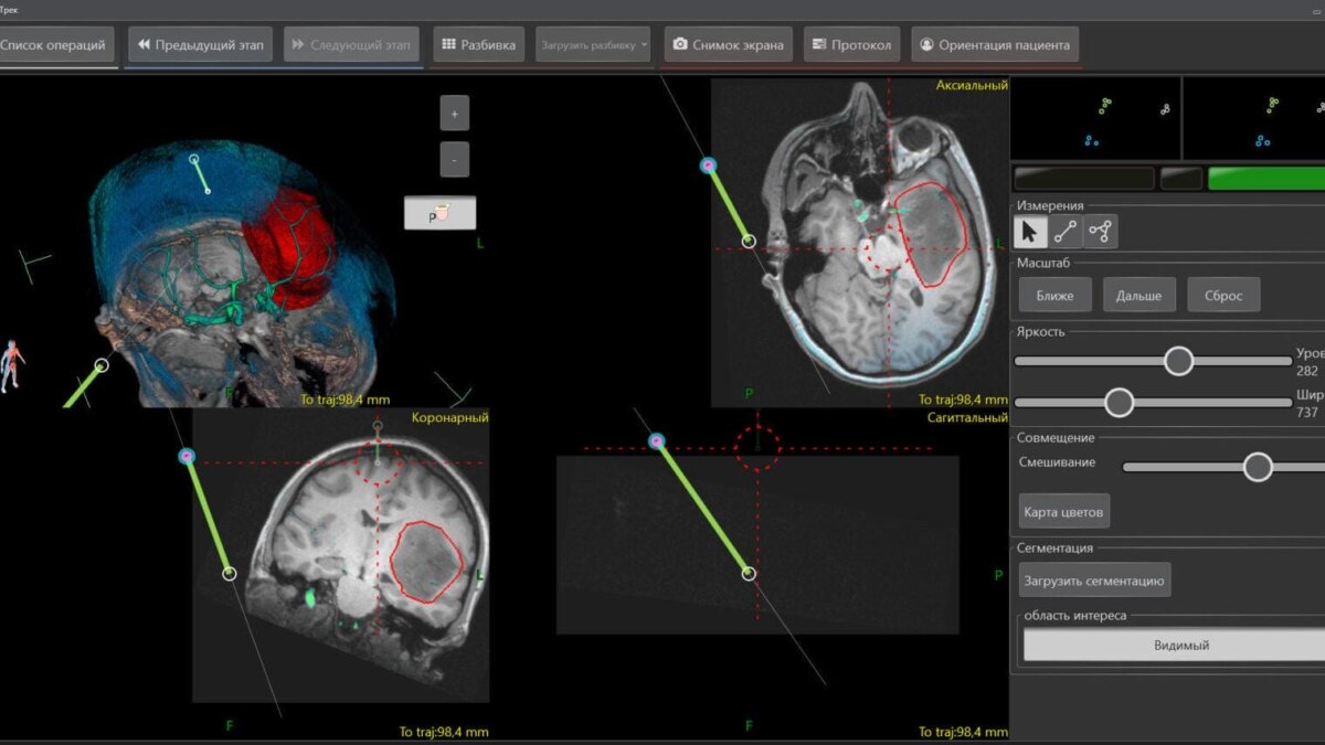 В Сеченовском университете тестируют первую российскую систему оптической навигации для операций на позвоночнике